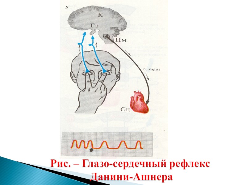 Рис. – Глазо-сердечный рефлекс  Данини-Ашнера